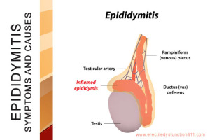 Epididymitis Image