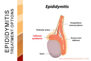 Epididymitis Treatment Options Image