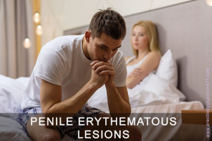 Penile Erythematous Lesions IMage