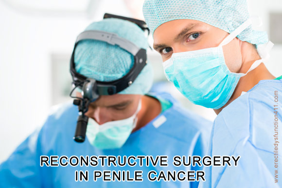 Reconstructive Surgery in Penile Cancer