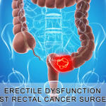 Erectile Dysfunction After Surgery for Rectal Cancer