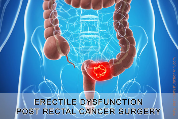 Erectile Dysfunction After Surgery for Rectal Cancer