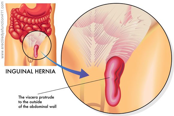 Testicular Stretching  Dr. Elist's Health Blog