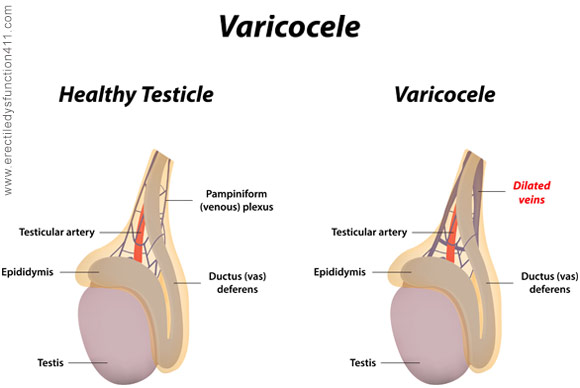Varicocele and Fertility