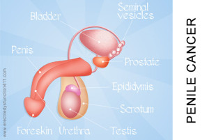 Penile Cancer Image